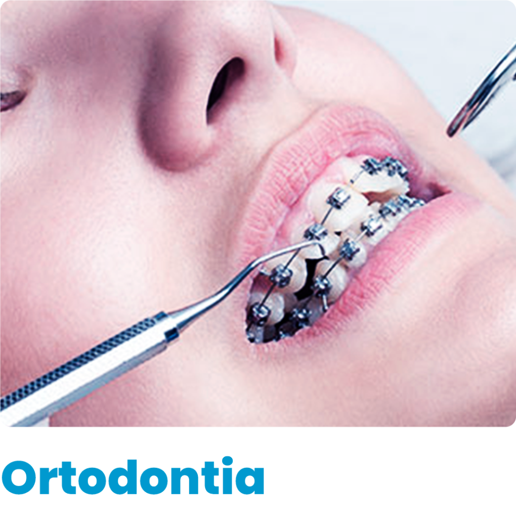 É uma especialidade odontológica que corrige a posição dos dentes e dos ossos maxilares posicionados de forma inadequada. Dentes tortos ou dentes que não se encaixam corretamente são difíceis de serem mantidos limpos, podendo ser perdidos precocemente, devido à deterioração e à doença periodontal.