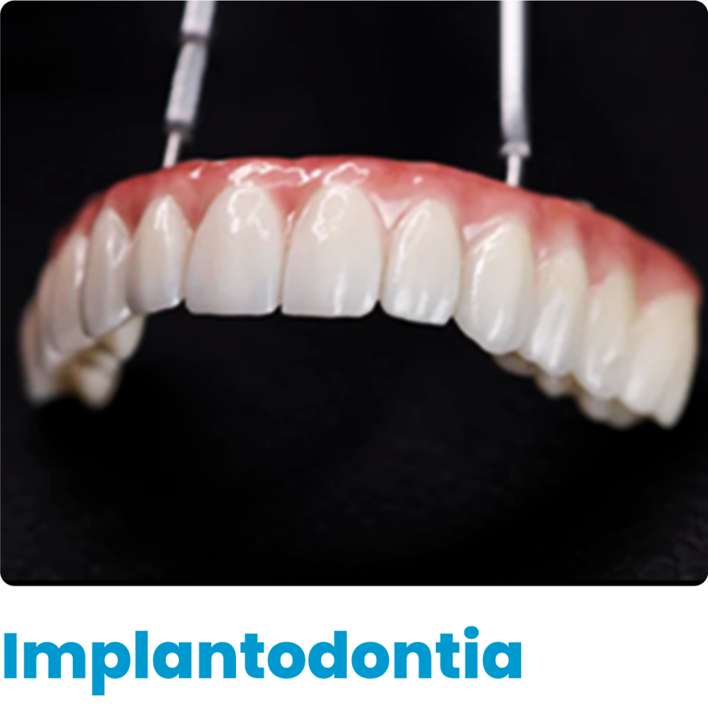 O trabalho da implantodontia consiste na reconstrução de parte do dente por meio de um implante, instalado no osso do maxilar ou mandíbula por processo cirúrgico